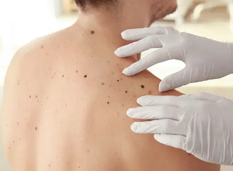 Kicking Skin Cancer Out of Construction